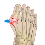 What Is a Bunion?